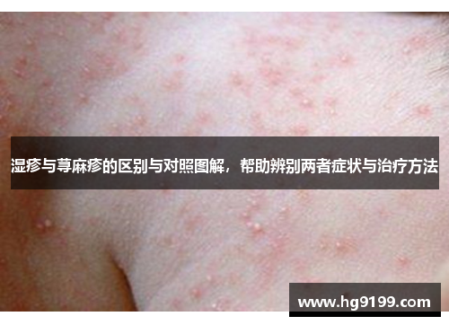 湿疹与荨麻疹的区别与对照图解，帮助辨别两者症状与治疗方法